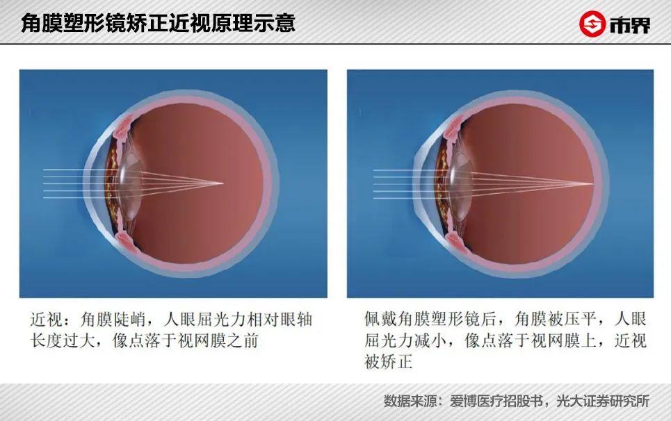 近视眼镜配多少钱的合适（价格上万元的OK镜究竟怎么样呢）